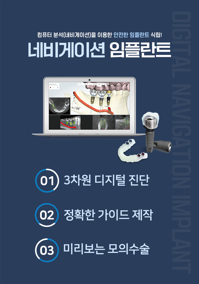 네비게이션 임플란트1