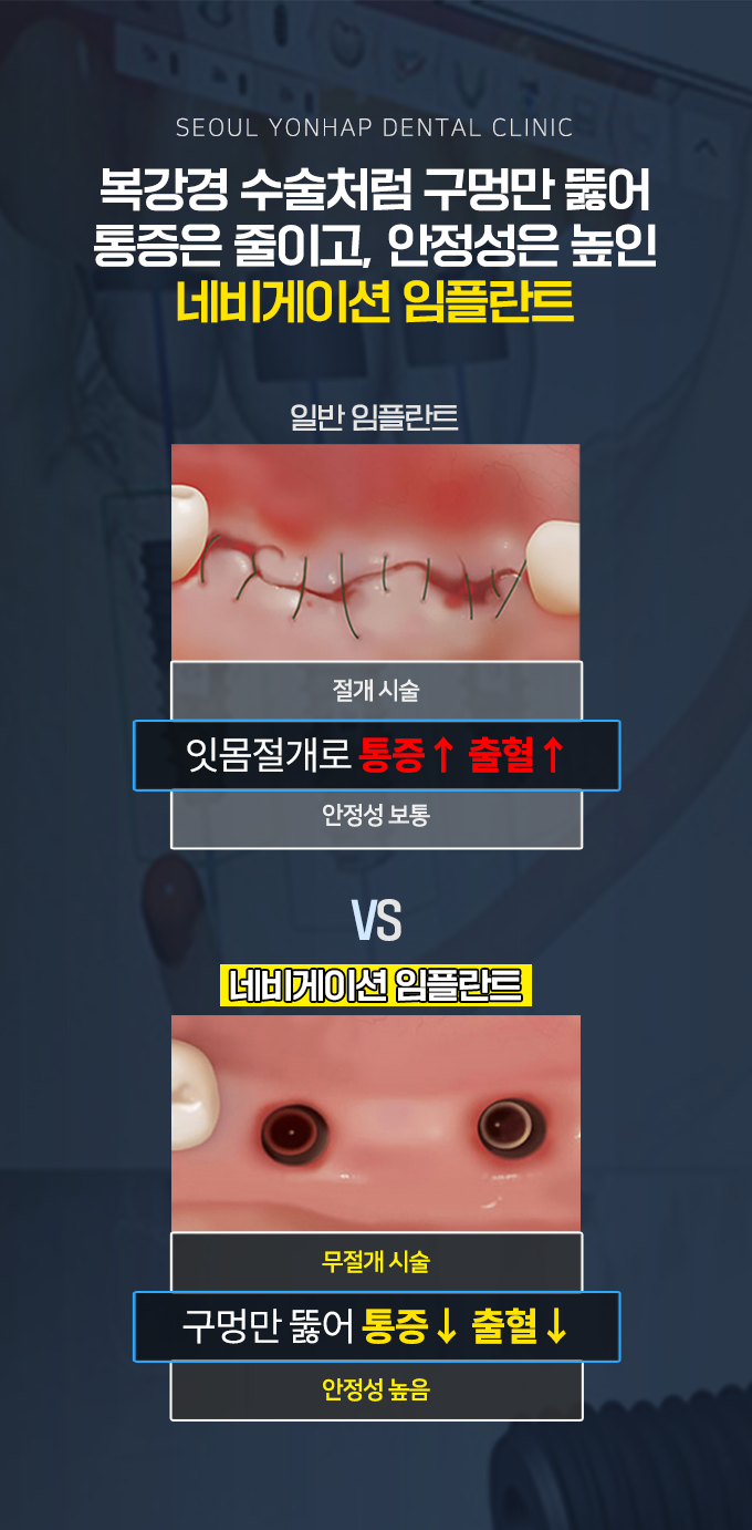 네비게이션 임플란트2