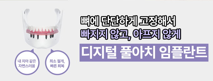 디지털 풀아치 임플란트1
