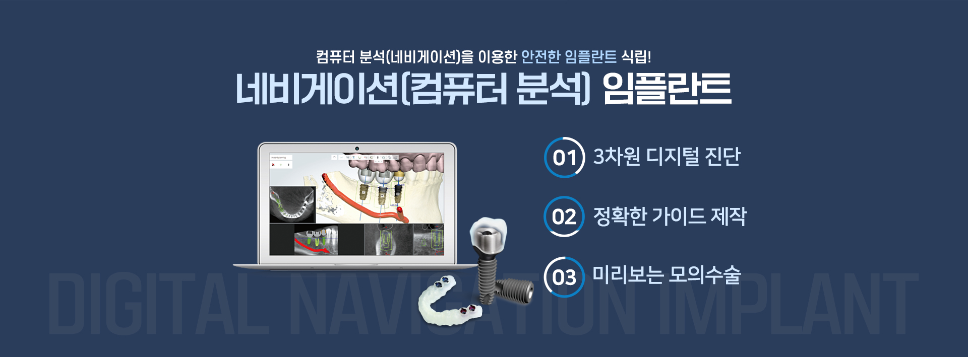 네비게이션 임플란트1