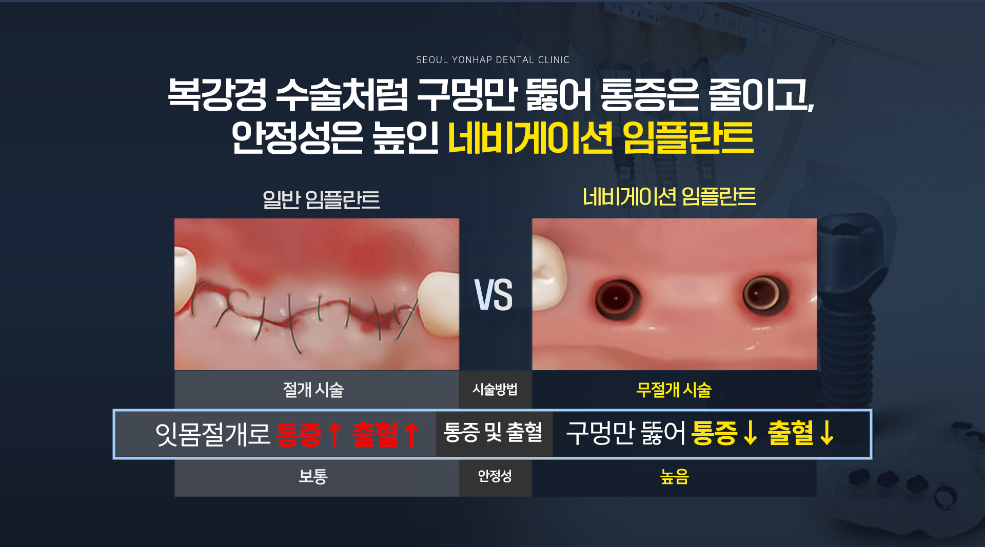 네비게이션 임플란트2