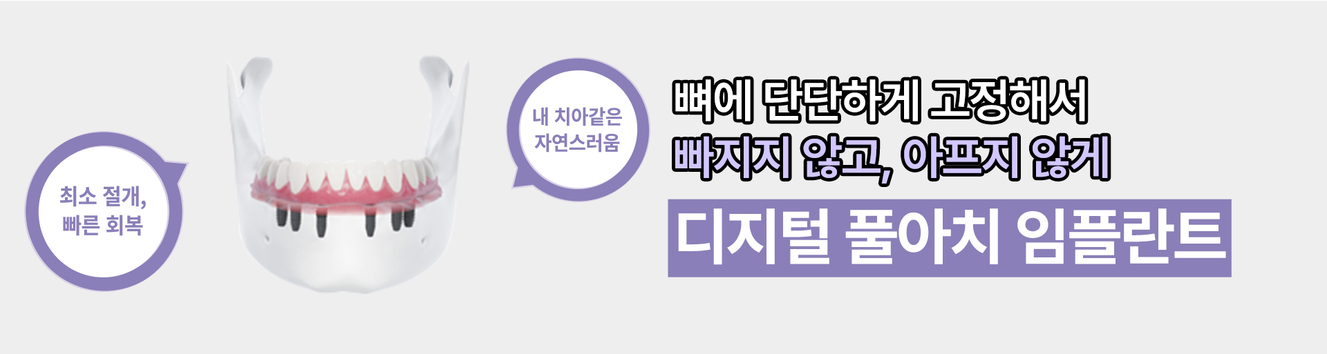 디지털 풀아치 임플란트1