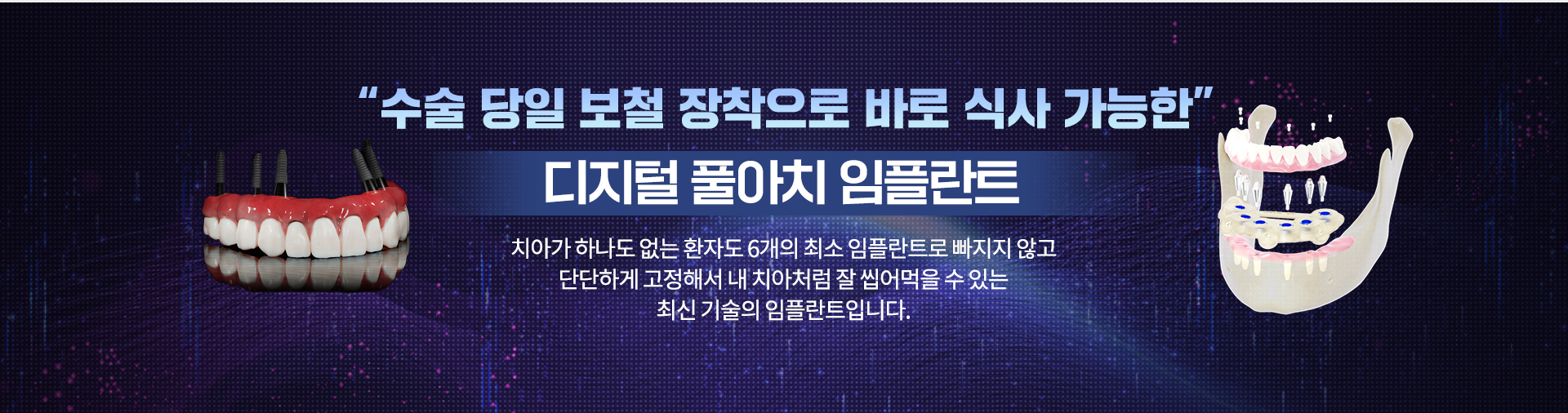 디지털 풀아치 임플란트2